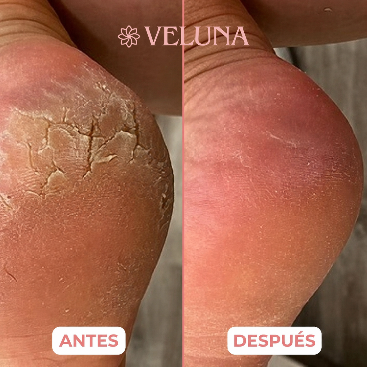Antes y después en un talón agrietado
